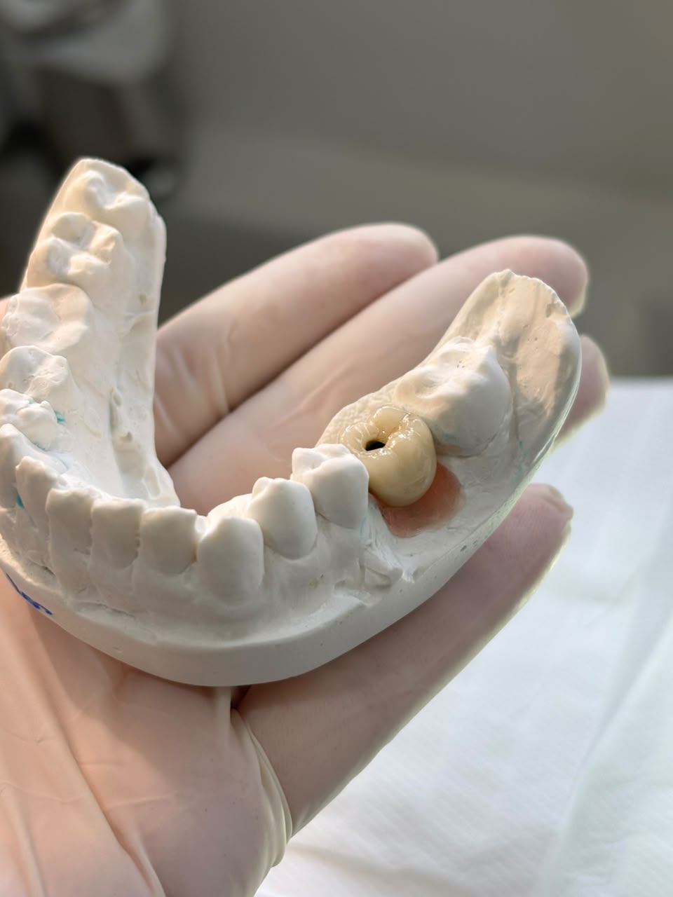 Caso clínico 6: modelo odontológico com prótese dentária